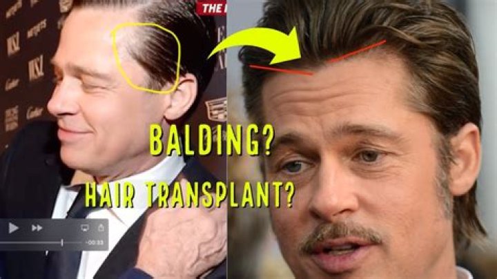 Did Brad Pitt Have Hair Transplants? Unraveling the Speculation