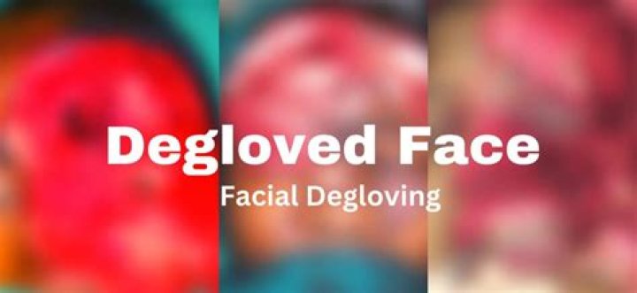 Disturbing Photos Of Degloved Faces: A Warning Graphic Image Alert