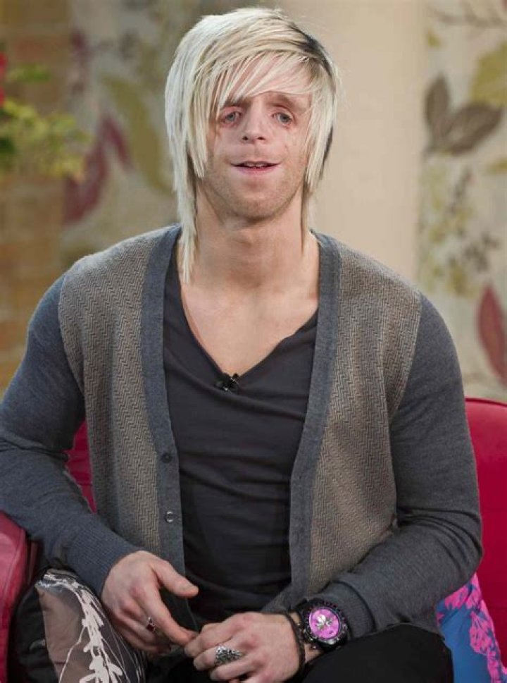 Inspiring Lives: Famous People With Treacher Collins Syndrome