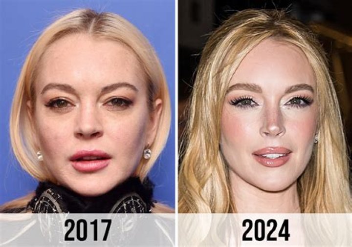 Lindsay Lohan's Plastic Surgery Journey Revealed