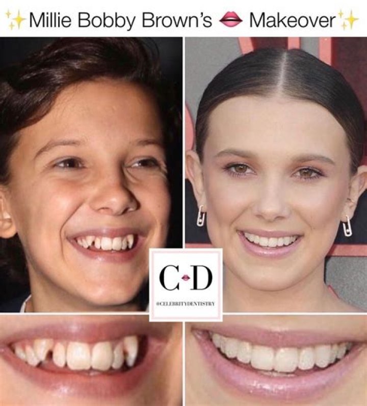 Millie Bobby Brown's Lip Fillers Journey