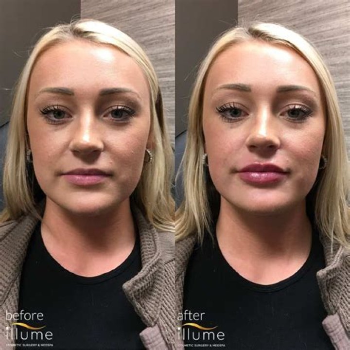 Sydney Sweeney's Natural Beauty Before Enhancements