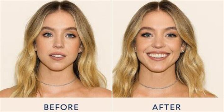 Sydney Sweeney's Plastic Surgery Journey
