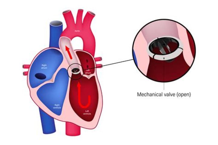 Unlocking Breakthroughs In Heart Valve Surgery