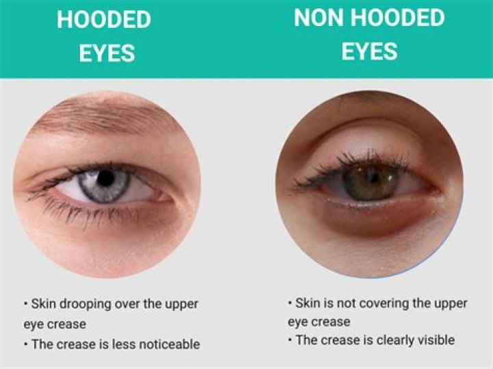 Unveil The Secrets: Hooded Eyes Vs Normal
